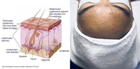 Hudproblem Pormaskar Acne Milier Rosacea Eksem Perioral Dermatit hudtest hudanalys online InCare